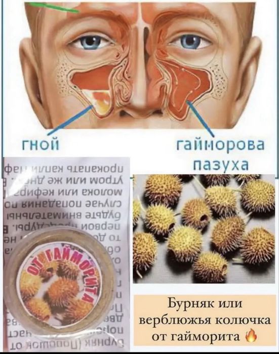 Бурнаки  от Гайморита