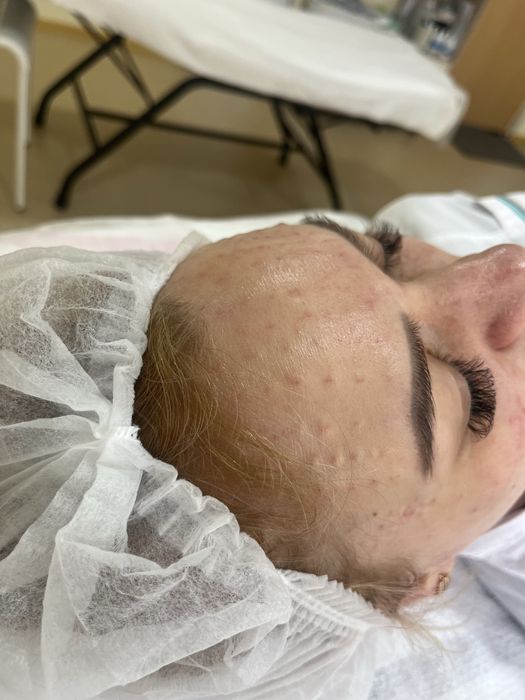 Увеличение губ,мезо,ботокс 30.000