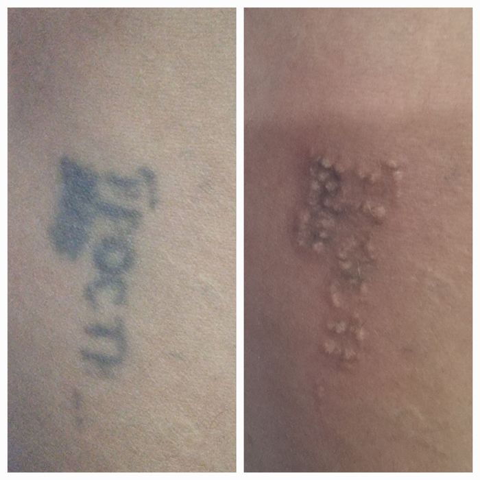 Удаление татуировок любой сложности от 200 тысяч сум