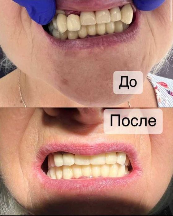 Качественное протезирование, металлокерамические коронки со скидкой