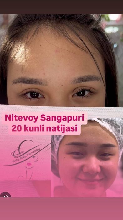 Лабга филлер ботекс