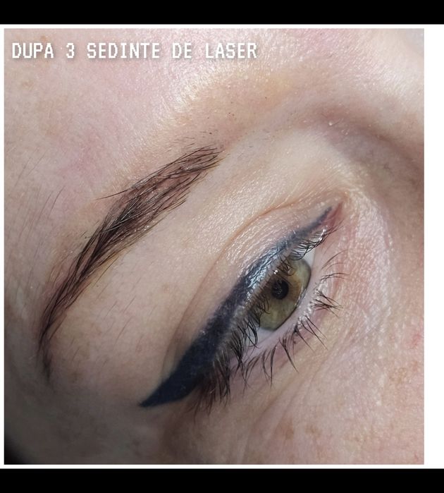 Îndepărtare tatuaj sprâncene și corp | Laser | PMU/Microblading