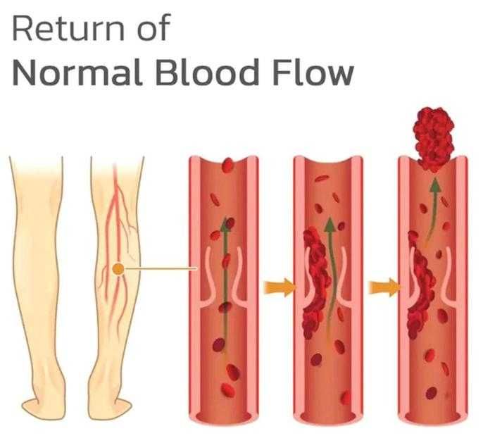 Лепенки При Флебит Атеросклероза Варикоза Пластири за Разширени Вени