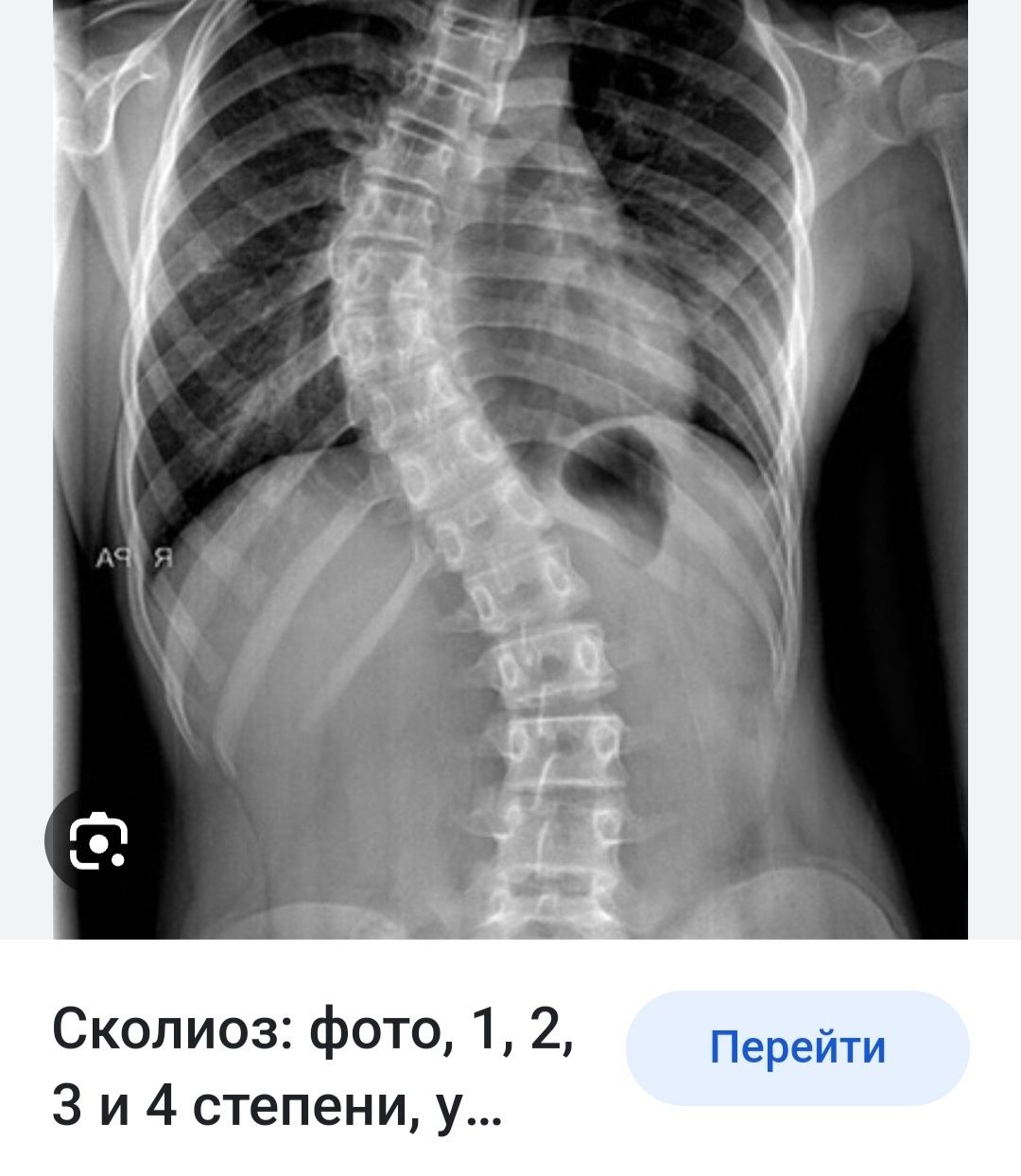 Сколиоз картинки. Сколиоз позвоночника рентген. Сколиотическая деформация позвоночника рентген. Сколиоз 3 степени грудного отдела рентген. Правосторонний сколиоз рентген.