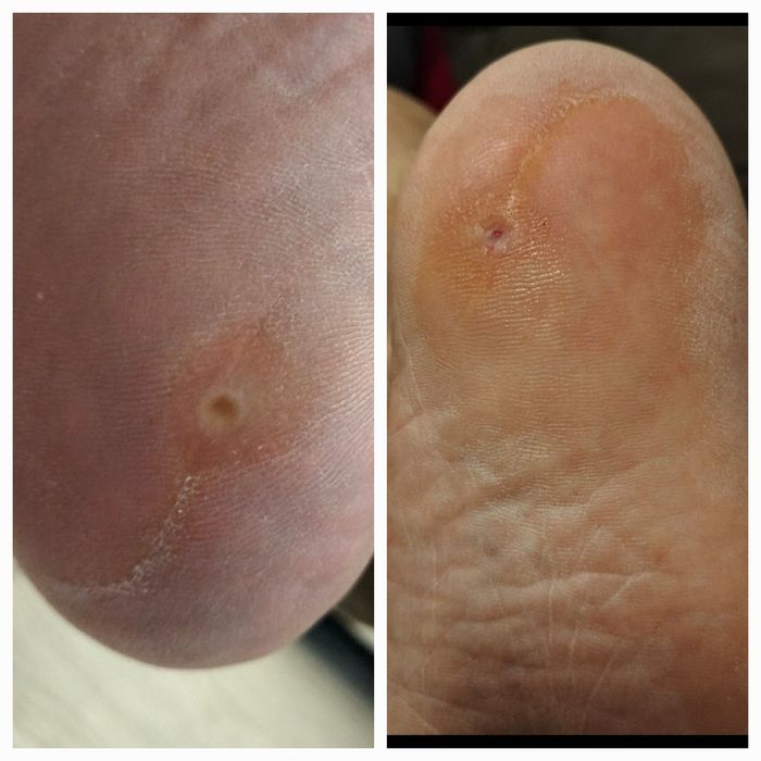 Pedichiura curativa