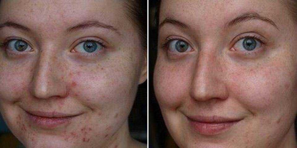 Чистка лица, Yuz tozalash, косметолог.