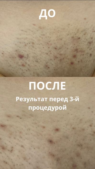 Лазерная эпиляция