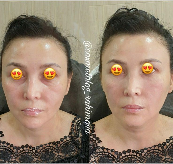 Придание обьема губам  500 тысяч  Косметология , уход, мезотерапия