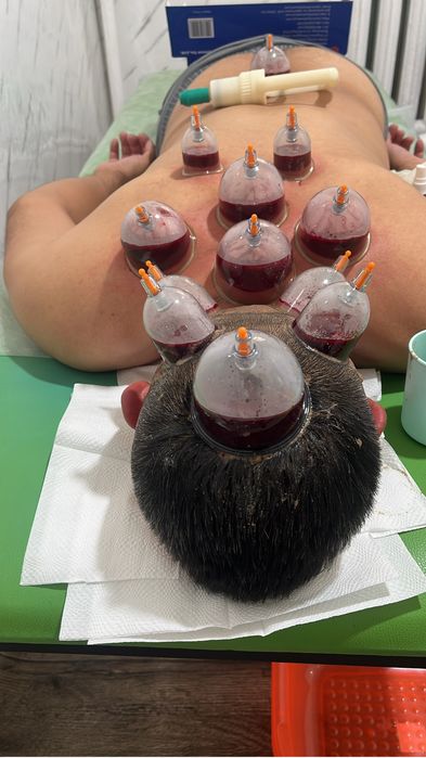 Хиджама и шертпе на выезд в городе Алматы