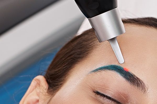 Акция Удаление татуаж брови лазером 200тысяч