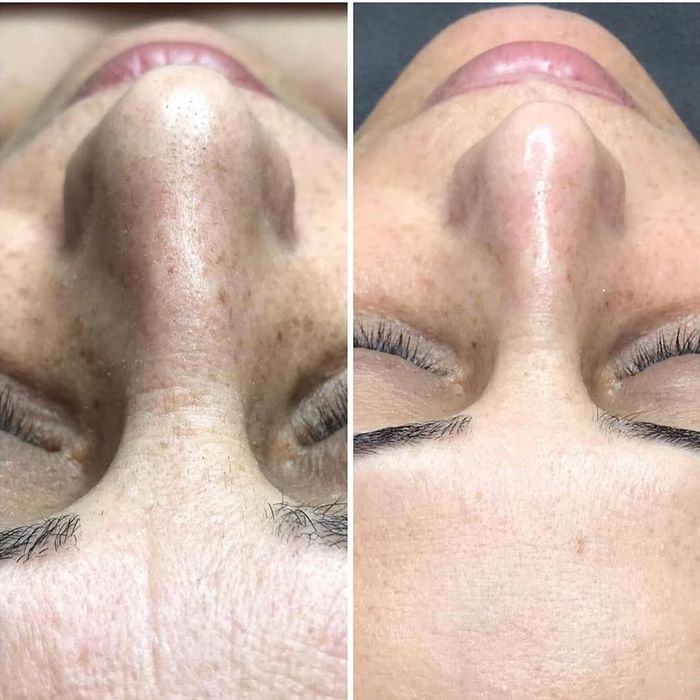 Миндальный пилинг. Увлажнение , сияние, омоложение