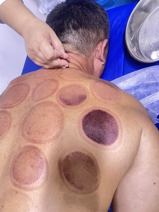 лечение Иглотерапией в Шымкентте