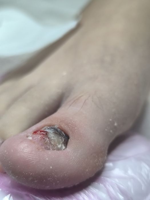 Медицински педикюр