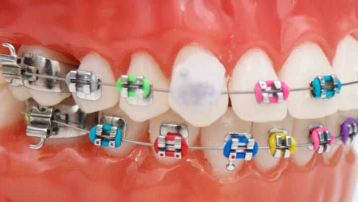 Воск для брекетов