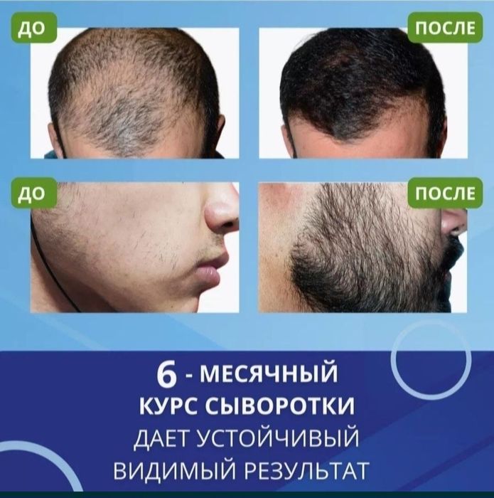 Сыворотка лысина рост волос