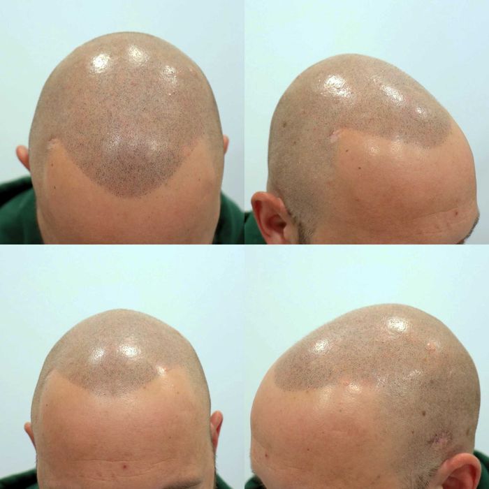 Caut modele pt micro pigmentare SMP scalp chelie / păr rar - tarif mic