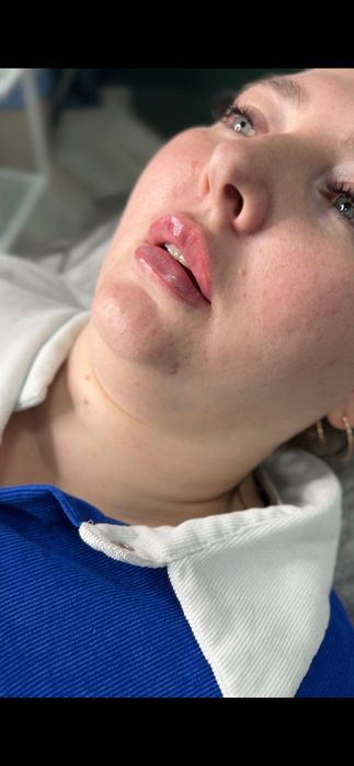 Скидки на увеличение губ