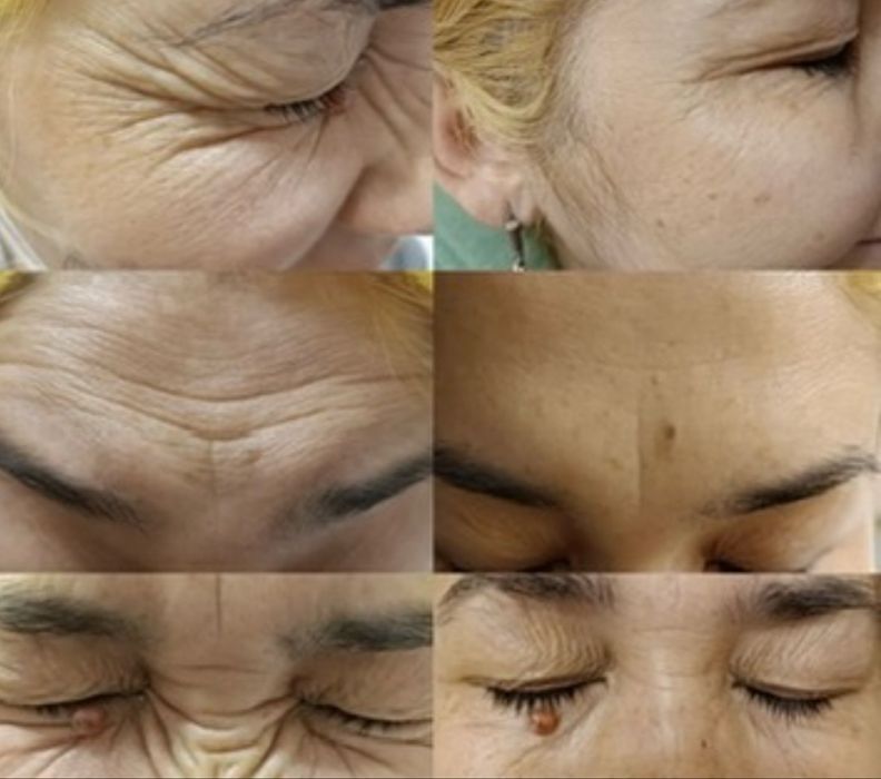 Требуются модели на косметологические процедуры