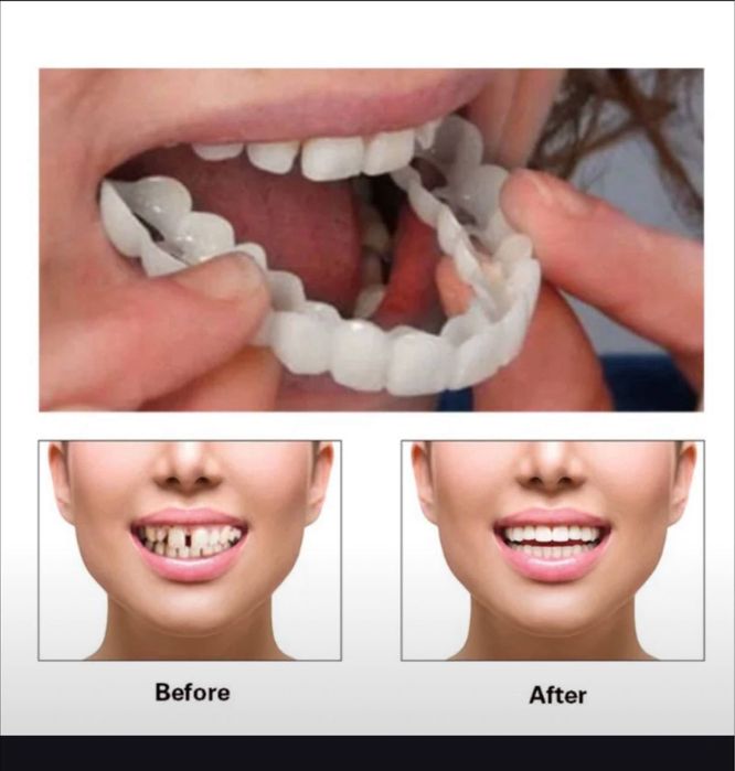 виниры для зубов съмнве