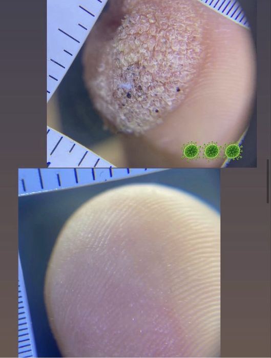 Подолог.Бородавки.Вросший ноготь