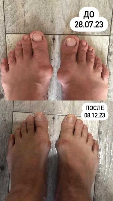 Коррекционные стельки