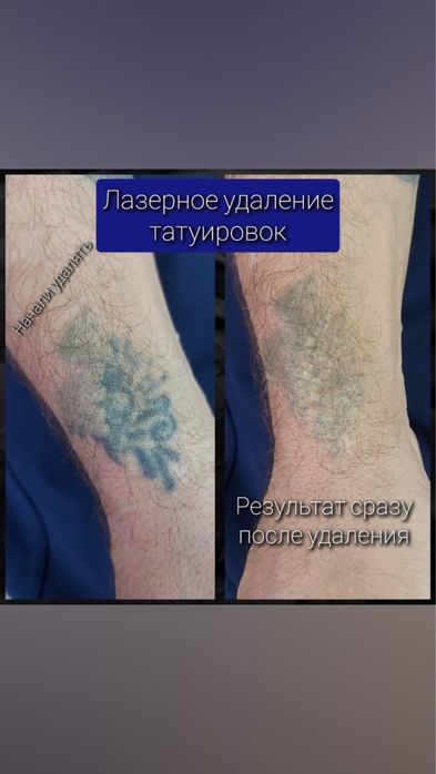 Продам лазер для удаления тату