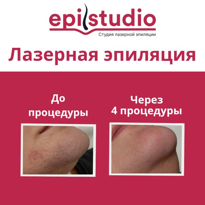 Лазерная эпиляция