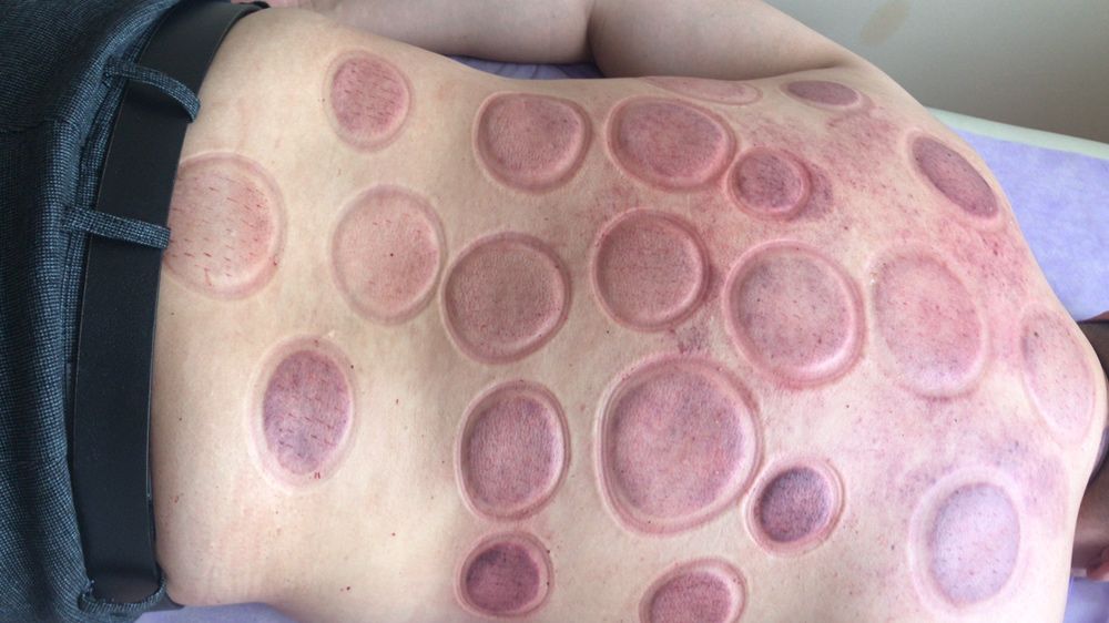 Банки Хиджамы 5тыс  Лезвие 5000тг