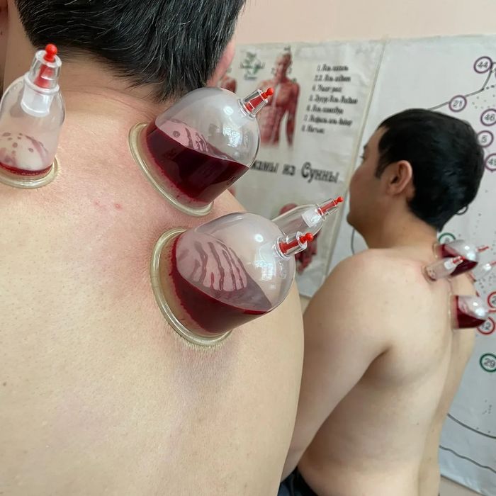 Хиджама профессионально