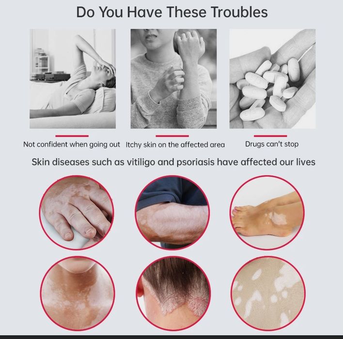 311 нм витилиго для псориаз лечения лампа новый оригинальный