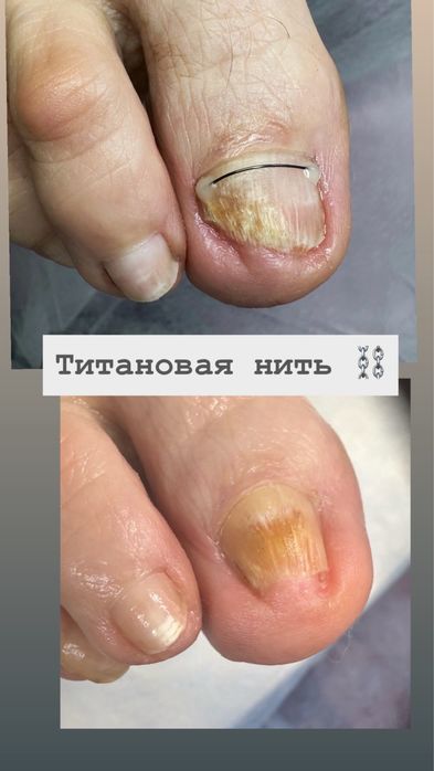 Акция на титановую нить10.000!Подолог.Вросший ноготь.Бородавки.Грибок