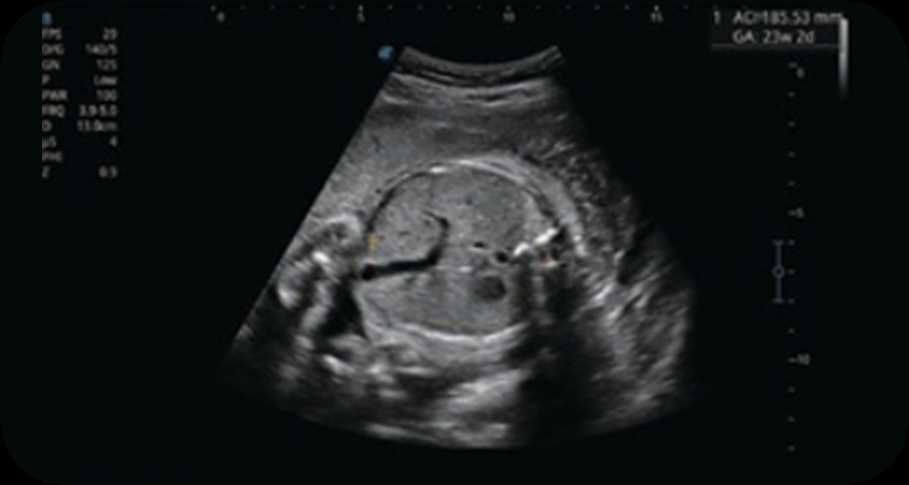 Sonoscape узи P9 elite
