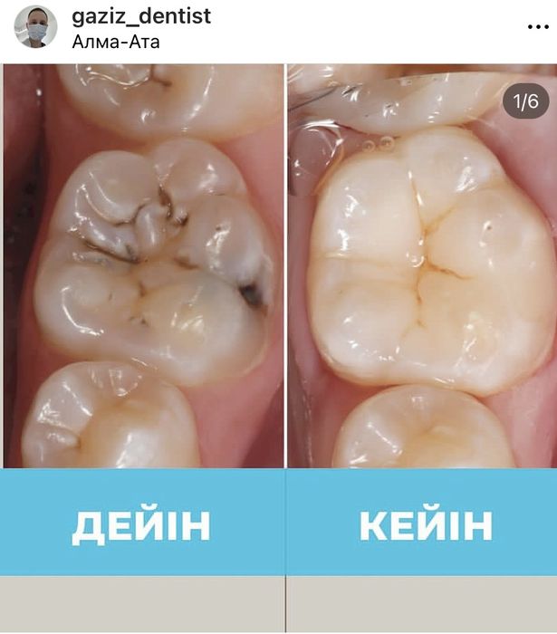Алматы тіс емдеу , стоматолог