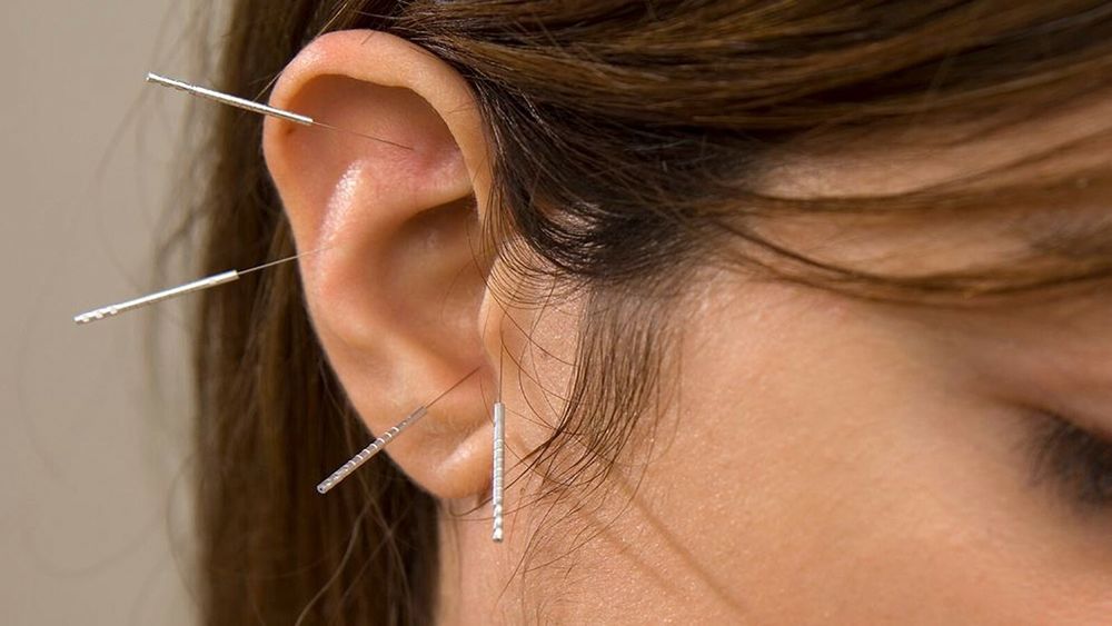 Эффективное лечение иглотеропией пивками хиджамой травами точечный мас