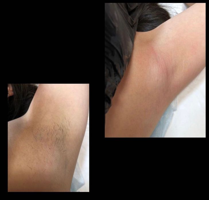 Шугаринг полимер воск