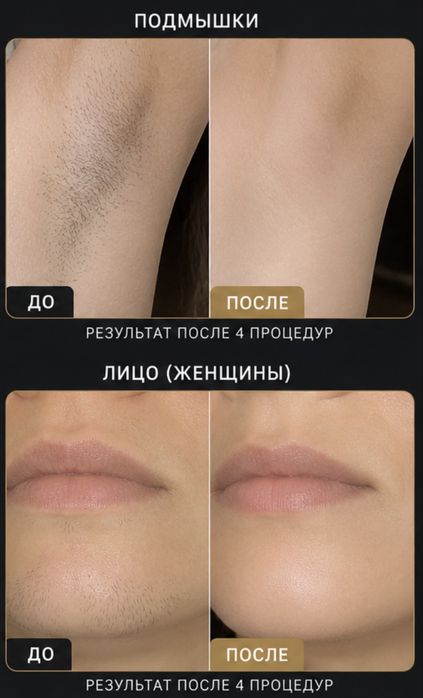 Продается лазерный аппарат SOPRANO TITANIUM