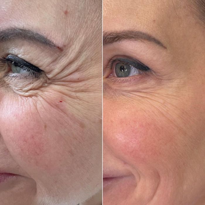 Ботокс Алматы АКЦИЯ