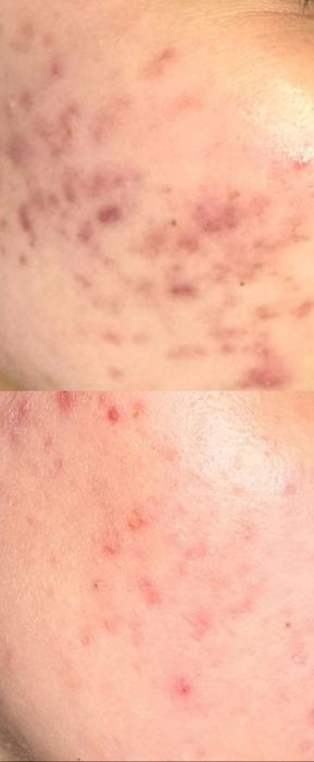 Tratamente faciale,curățare ten,hidratare,extracții,masaj facial