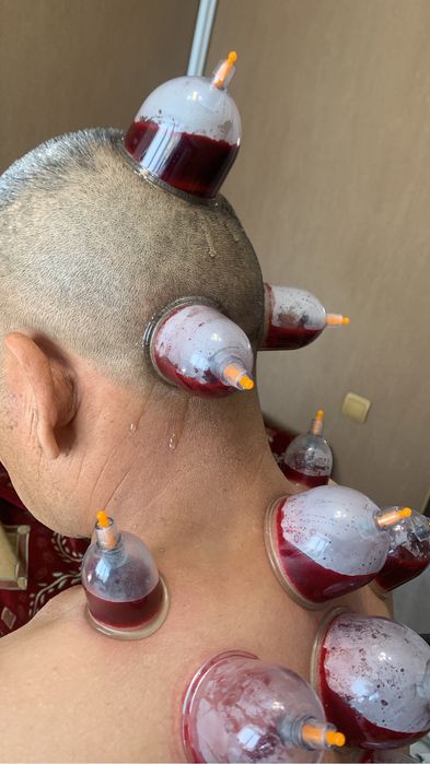 Пиявки хиджама