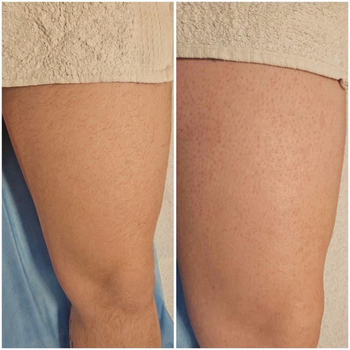 Epilare femei și bărbați, tratament cu parafina mâini și picioare