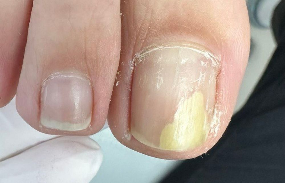 Проблемы с ногами (стопами) и ногтями