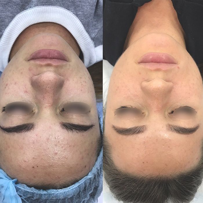 Акция на плазмолифтинг