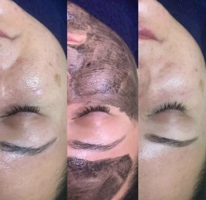 Карбоновый пилинг,7000  омоложение