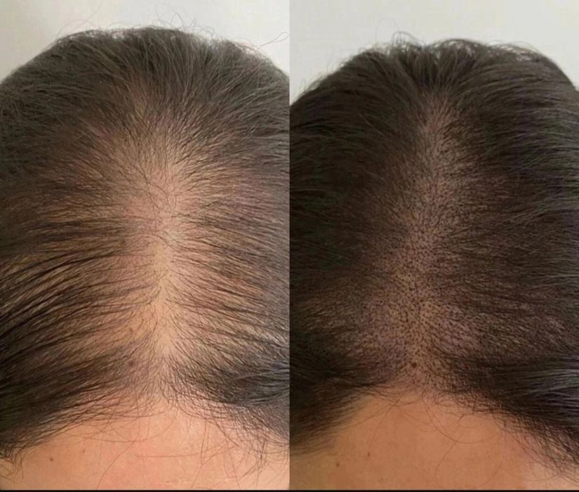 Трихопигментация волос