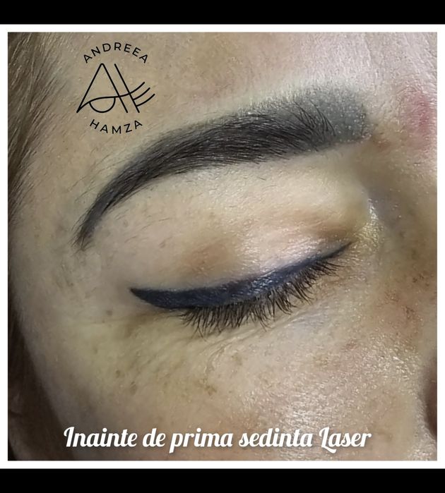 Îndepărtare tatuaj sprâncene și corp | Laser | PMU/Microblading