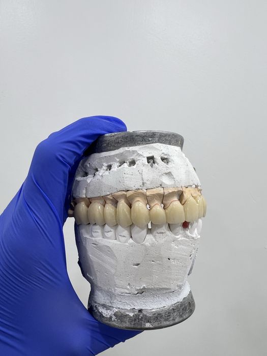 Цирконий / E-max за 2–3 дня | Luminora Dental