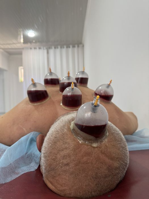 Мануальная терапия, хиджама