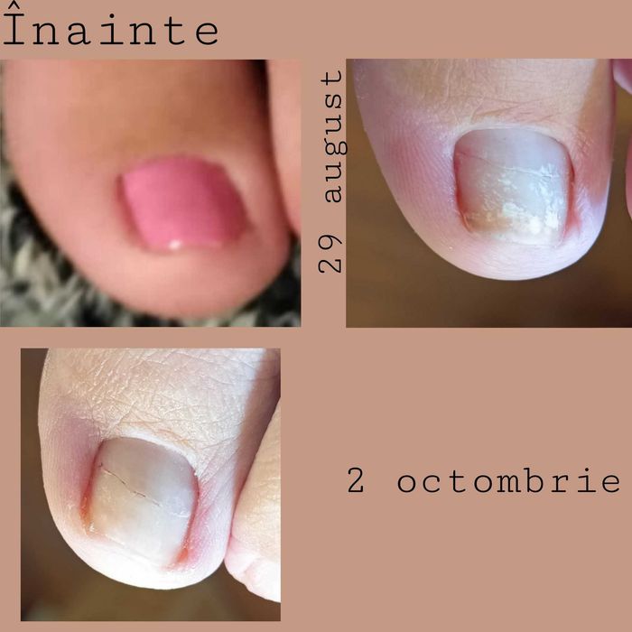 Pedichiură medicală Târgu Mureș