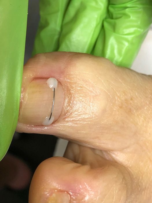 Pedichiura medicala.Instrumentar sterilizat in autoclav.Liftup gel