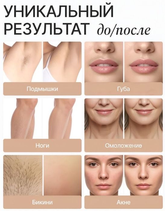 I'MDEX фотоэпилятор